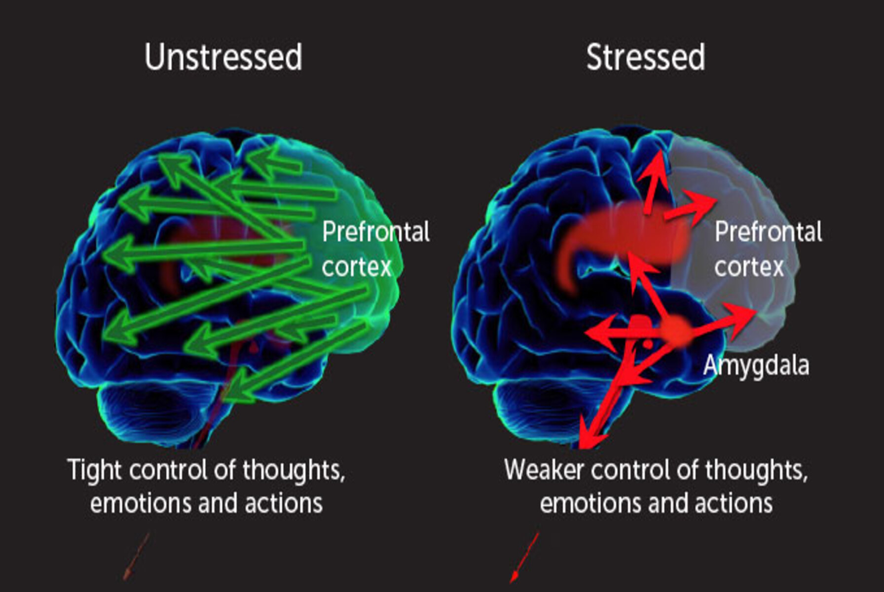 A detailed illustration showing the effects of chronic stress on brain function highlighting areas like the hippocampus and amygdala